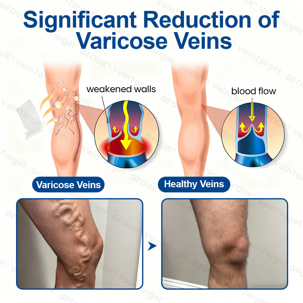 🎁GFOUK® VeinTarget Microneedle Patch⚡Instant Relief, Long-Term Results